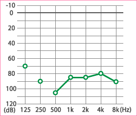メニエール病：難聴の聴力水平型